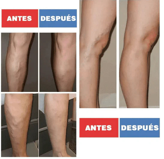 VARICOSE - PARCHES PARA ELIMINAR LAS VARICES